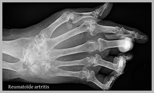 Arthritis Amstelveen