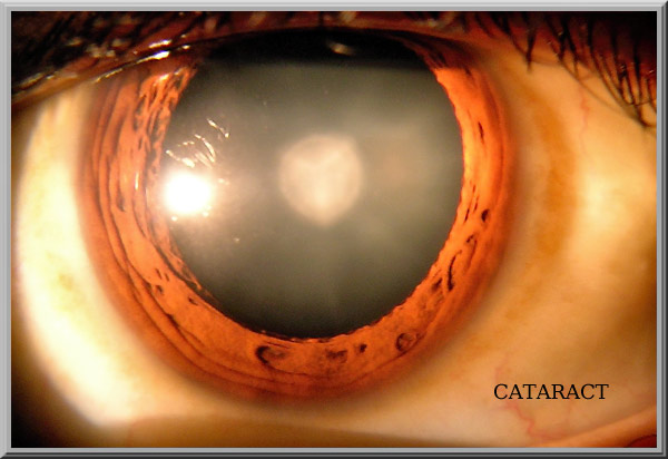 Cataract Amstelveen